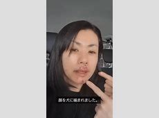 タレント・小島可奈子さんが犬に襲われた！医師が語る30針の傷の影響
